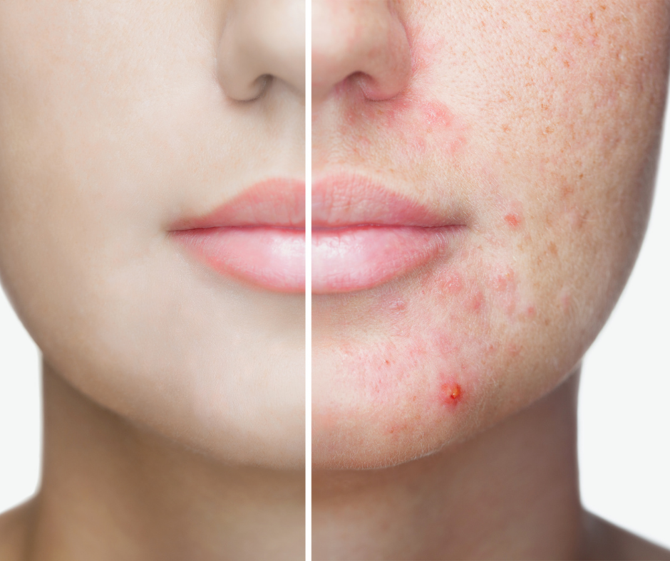 Model lower face with one side clear complexion and the other side has acne
