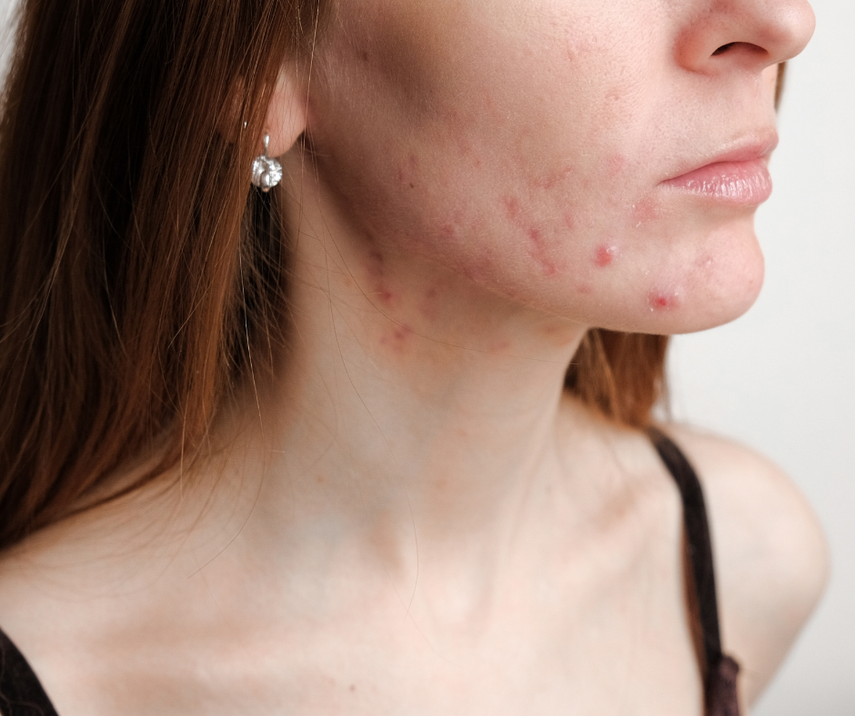 Female model lower face showing acne 