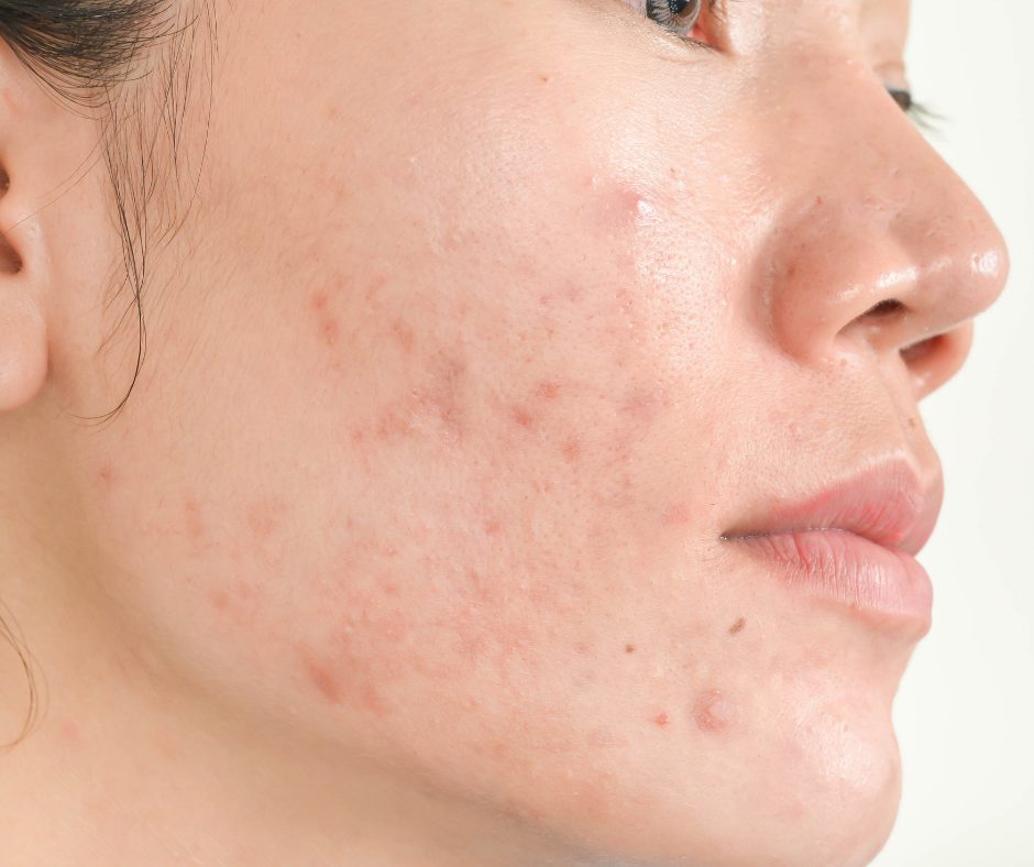 Acne-Prone Skin