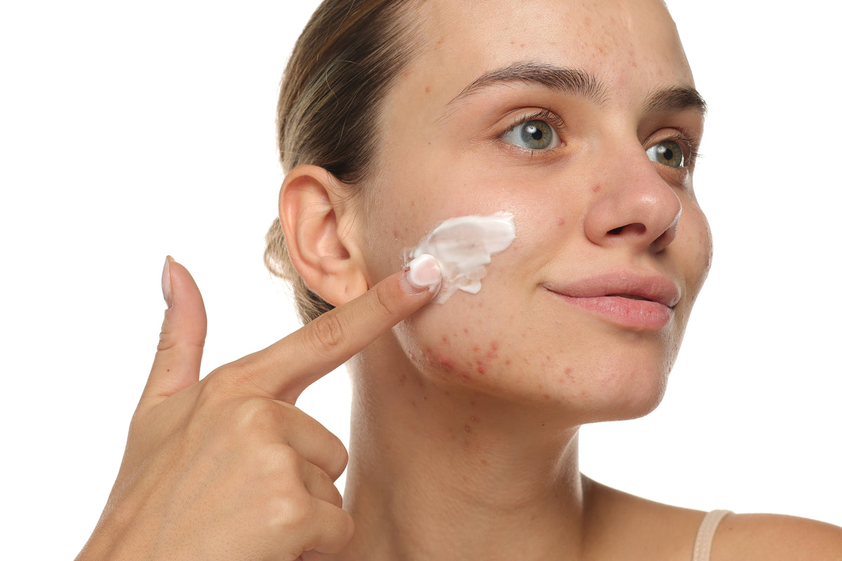 Split image comparing clear calm skin on the left with active acne and redness on the right